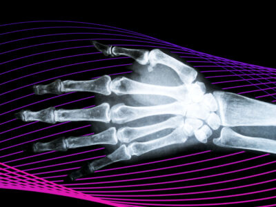 An X-ray of a hand