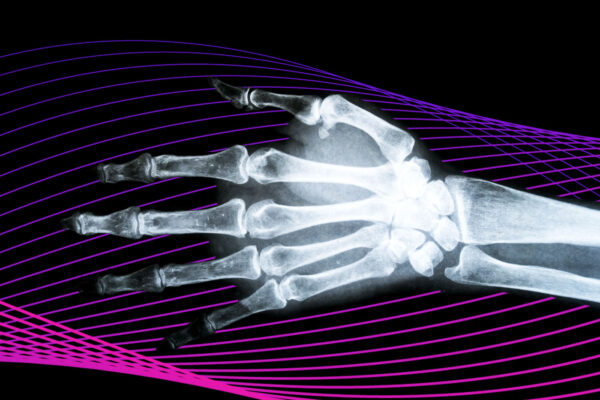 An X-ray of a hand