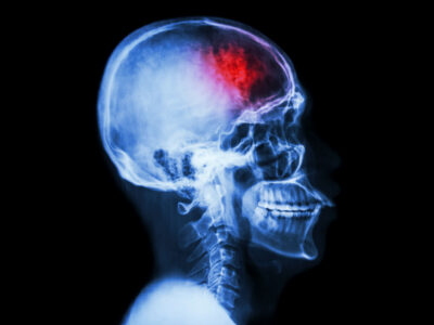 An illustration depicting brain activity on an X-ray slide
